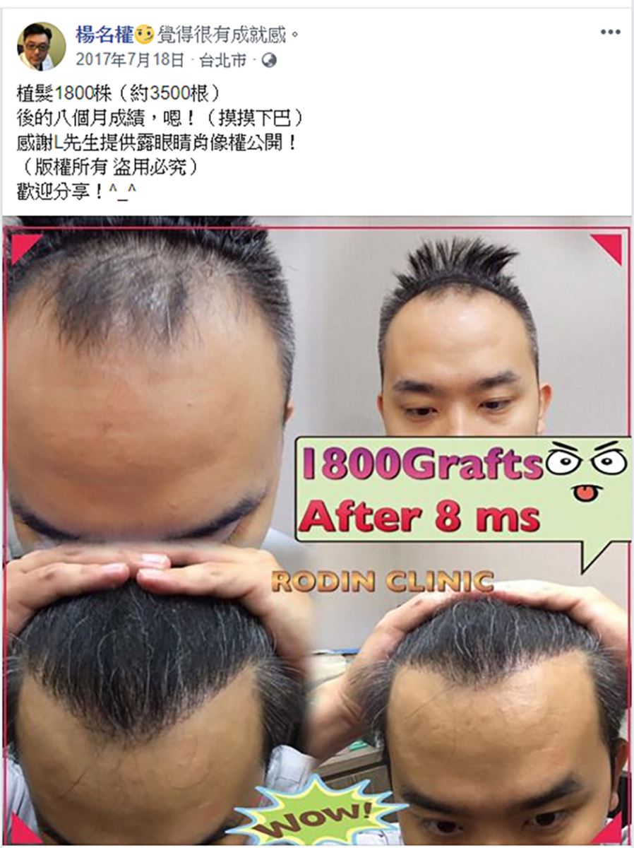 植髮,生髮,楊名權,楊氏羅丹